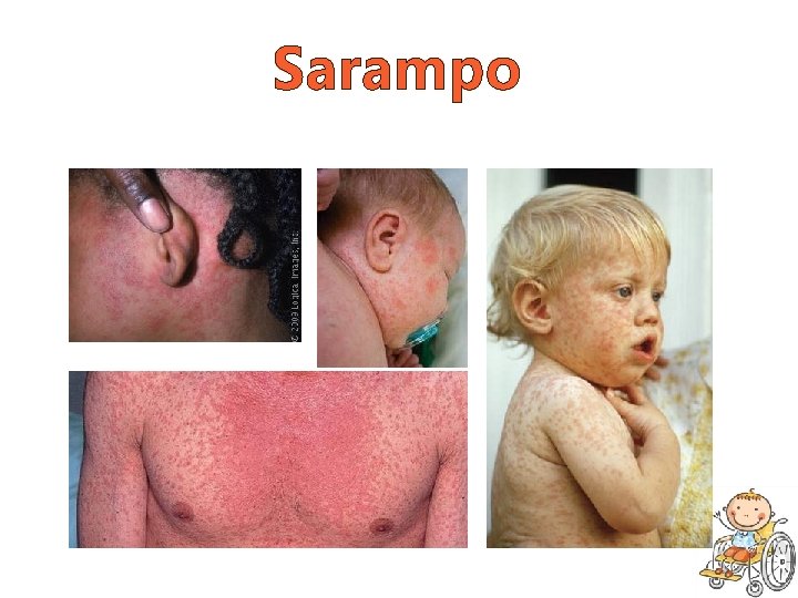 Sarampo 