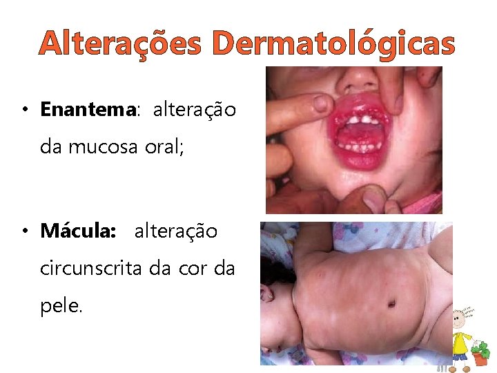 Alterações Dermatológicas • Enantema: alteração da mucosa oral; • Mácula: alteração circunscrita da cor