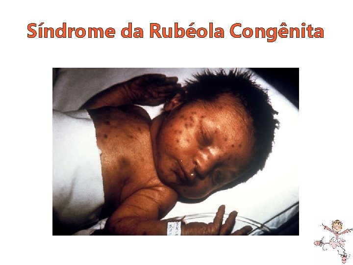 Síndrome da Rubéola Congênita 