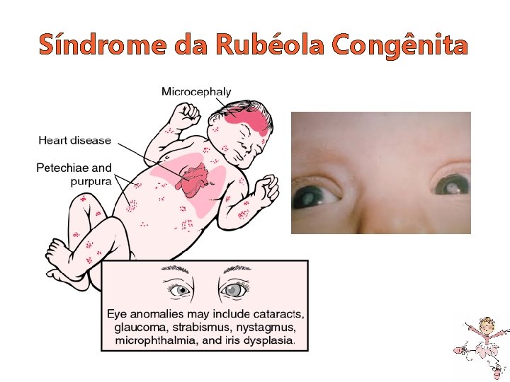 Síndrome da Rubéola Congênita 