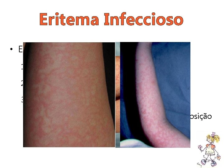 Eritema Infeccioso • Exantema 1. Face esbofeteada 2. Eritema macular difuso (1 -4 dias