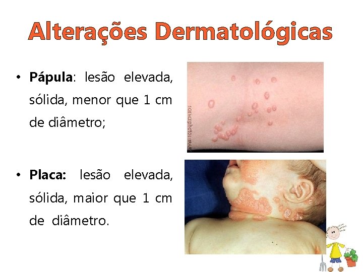 Alterações Dermatológicas • Pápula: lesão elevada, sólida, menor que 1 cm de diâmetro; •