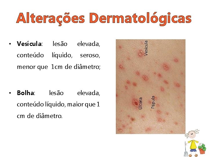 Alterações Dermatológicas • Vesícula: conteúdo lesão líquido, elevada, seroso, menor que 1 cm de