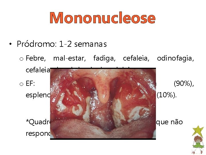 Mononucleose • Pródromo: 1 -2 semanas o Febre, mal-estar, fadiga, cefaleia, odinofagia, cefaleia, dor