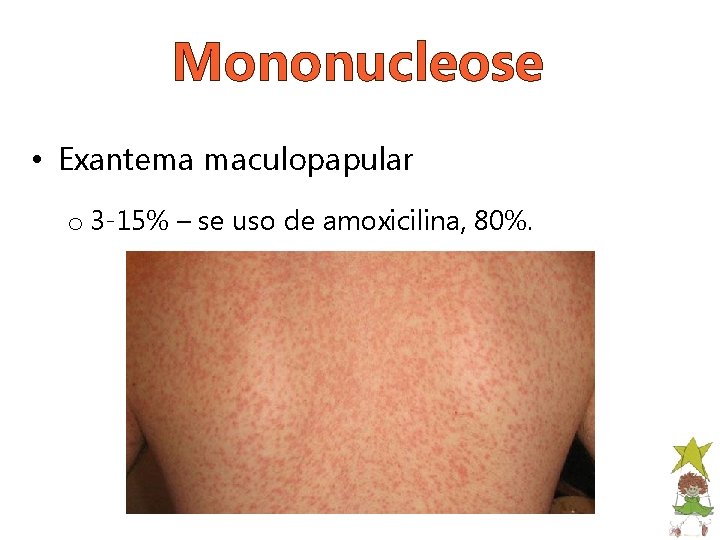 Mononucleose • Exantema maculopapular o 3 -15% – se uso de amoxicilina, 80%. 