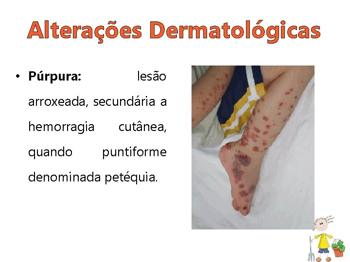 Alterações Dermatológicas • Púrpura: lesão arroxeada, secundária a hemorragia quando cutânea, puntiforme denominada petéquia.