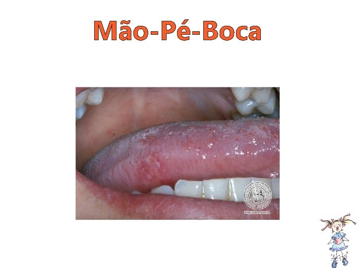 Mão-Pé-Boca 