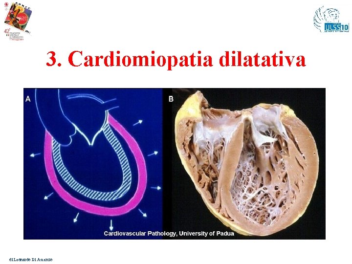 3. Cardiomiopatia dilatativa di Leonardo Di Ascenzo 