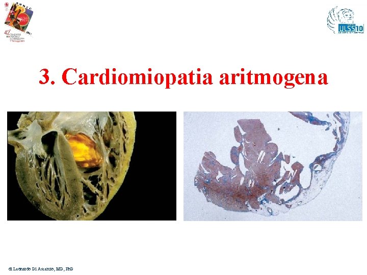 3. Cardiomiopatia aritmogena di Leonardo Di Ascenzo, MD, Ph. D 