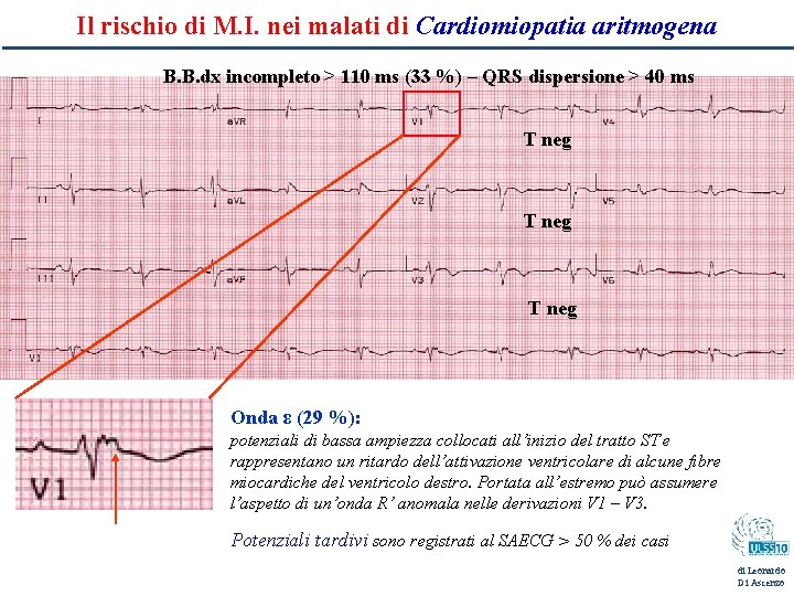 Il rischio di M. I. nei malati di Cardiomiopatia aritmogena B. B. dx incompleto