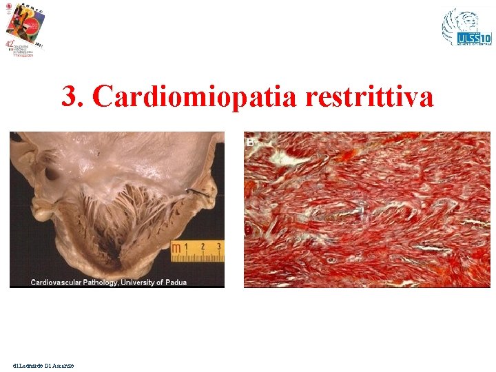 3. Cardiomiopatia restrittiva di Leonardo Di Ascenzo 