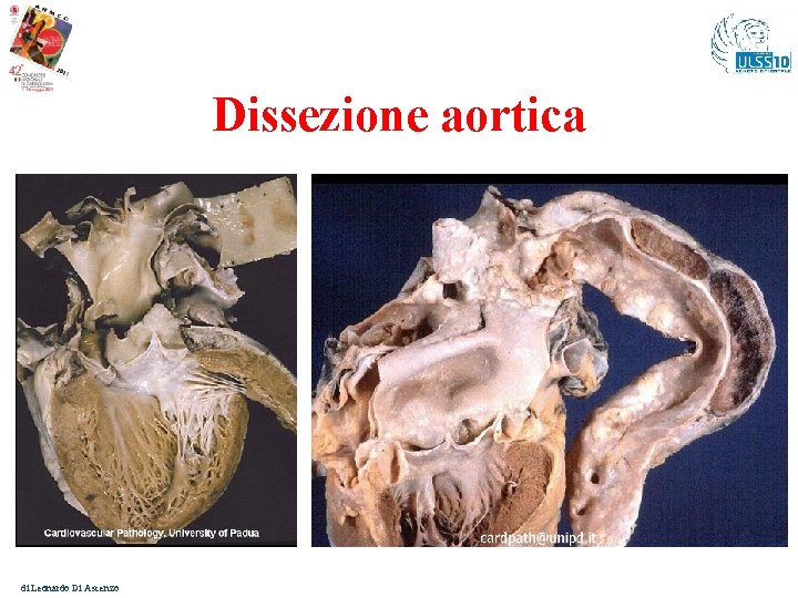 Dissezione aortica di Leonardo Di Ascenzo 