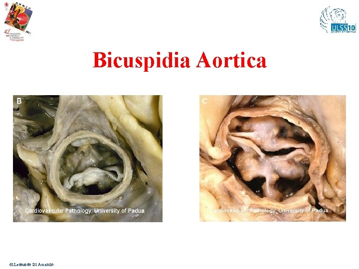 Bicuspidia Aortica di Leonardo Di Ascenzo 