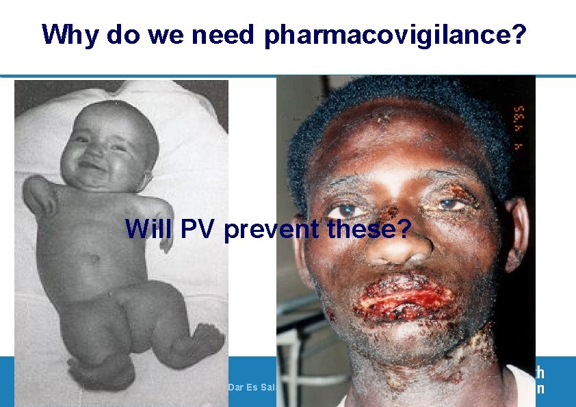 Why do we need pharmacovigilance? Will PV prevent these? 3| PV of ARVs, 23