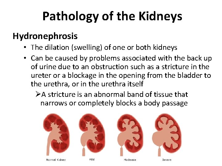 Pathology of the Kidneys Hydronephrosis • The dilation (swelling) of one or both kidneys