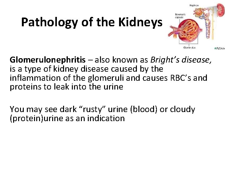 Pathology of the Kidneys Glomerulonephritis – also known as Bright’s disease, is a type