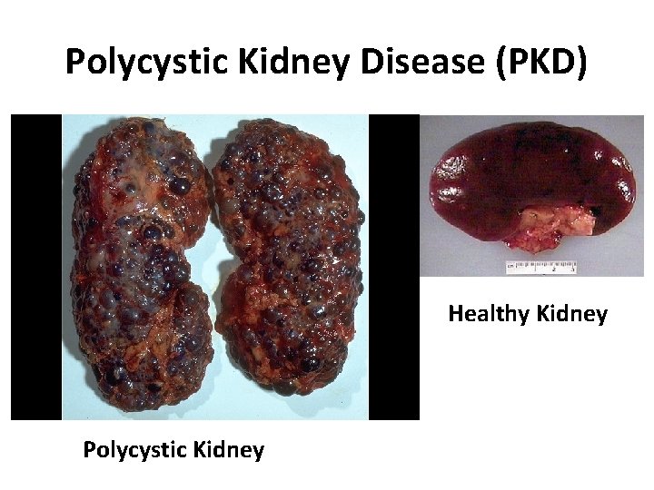 Polycystic Kidney Disease (PKD) Healthy Kidney Polycystic Kidney 