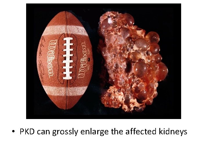 • PKD can grossly enlarge the affected kidneys 