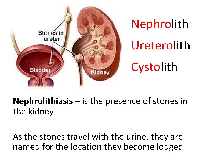 Nephrolith Ureterolith Cystolith Nephrolithiasis – is the presence of stones in the kidney As