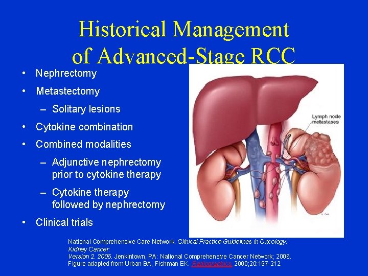 Historical Management of Advanced-Stage RCC • Nephrectomy • Metastectomy – Solitary lesions • Cytokine