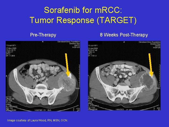 Sorafenib for m. RCC: Tumor Response (TARGET) Pre-Therapy Image courtesy of Laura Wood, RN,