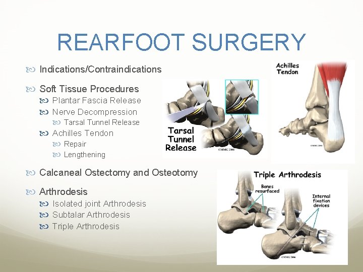 REARFOOT SURGERY Indications/Contraindications Soft Tissue Procedures Plantar Fascia Release Nerve Decompression Tarsal Tunnel Release REARFOOT SURGERY Indications/Contraindications Soft Tissue Procedures Plantar Fascia Release Nerve Decompression Tarsal Tunnel Release