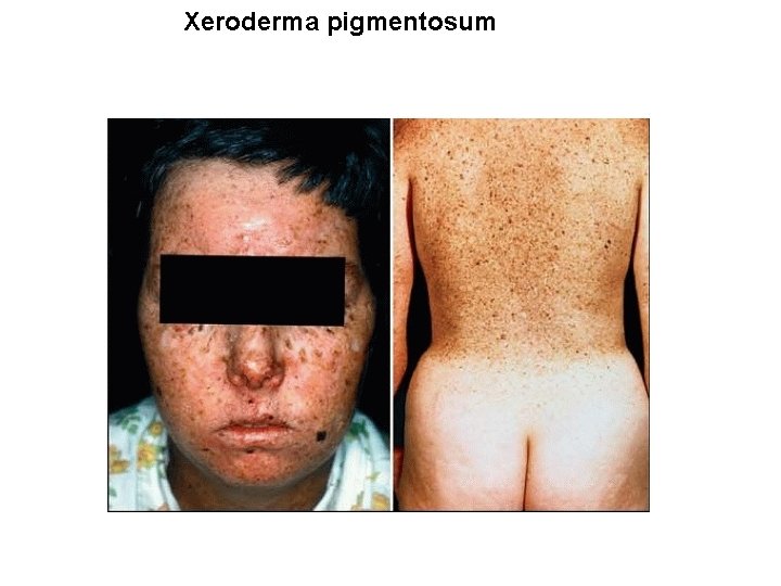 Xeroderma pigmentosum 