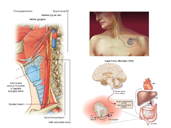 Vagus Nerve Stimulator (VNS) 