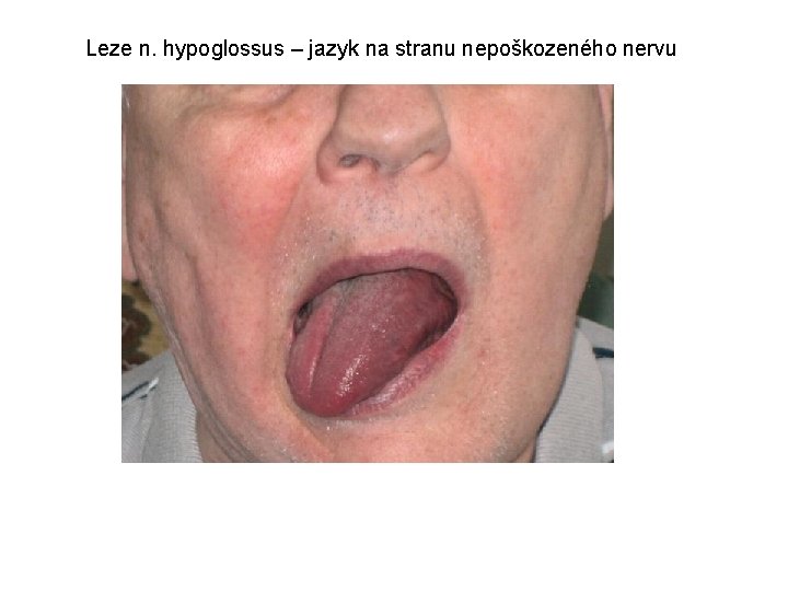 Leze n. hypoglossus – jazyk na stranu nepoškozeného nervu 