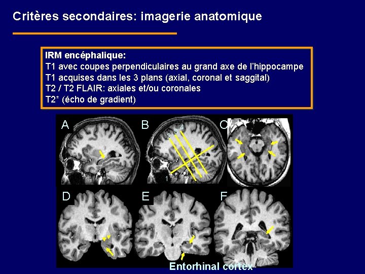 Critères secondaires: imagerie anatomique IRM encéphalique: T 1 avec coupes perpendiculaires au grand axe
