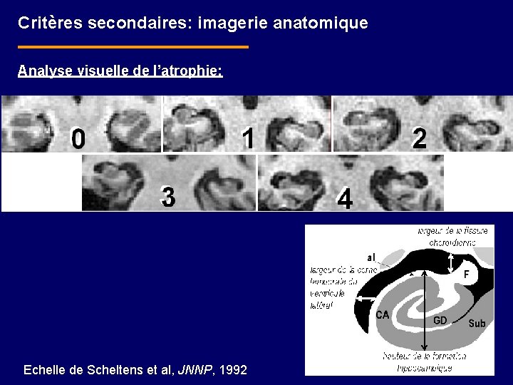 Critères secondaires: imagerie anatomique Analyse visuelle de l’atrophie: Echelle de Scheltens et al, JNNP,
