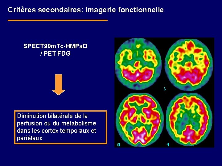 Critères secondaires: imagerie fonctionnelle SPECT 99 m. Tc-HMPa. O / PET FDG Diminution bilatérale