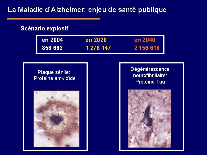 La Maladie d’Alzheimer: enjeu de santé publique Scénario explosif en 2004 856 662 Plaque