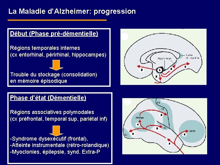 La Maladie d’Alzheimer: progression Début (Phase pré-démentielle) Régions temporales internes (cx entorhinal, périrhinal, hippocampes)