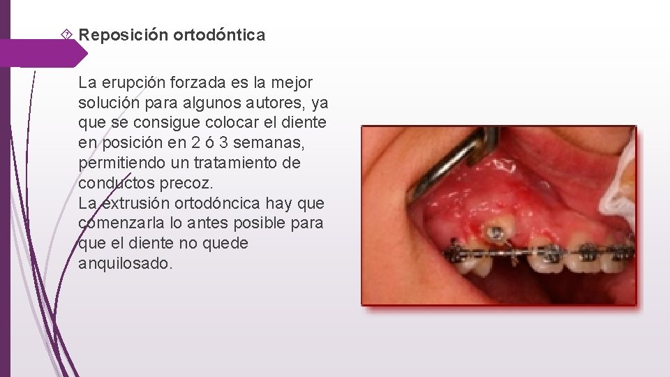  Reposición ortodóntica La erupción forzada es la mejor solución para algunos autores, ya