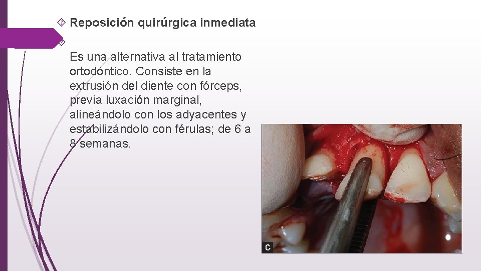  Reposición quirúrgica inmediata Es una alternativa al tratamiento ortodóntico. Consiste en la extrusión