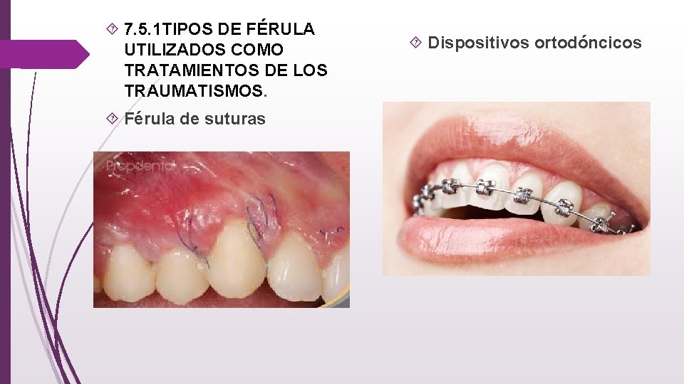  7. 5. 1 TIPOS DE FÉRULA UTILIZADOS COMO TRATAMIENTOS DE LOS TRAUMATISMOS. Férula
