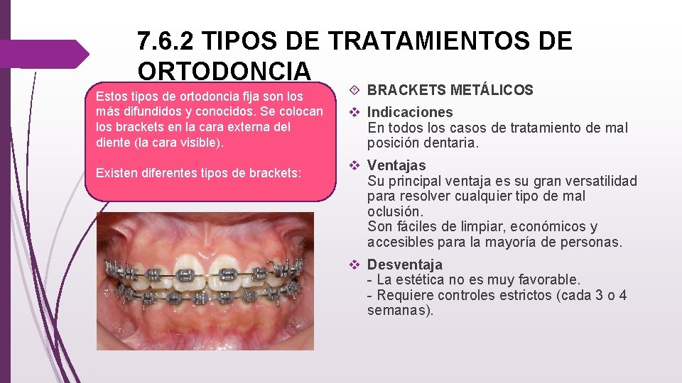 7. 6. 2 TIPOS DE TRATAMIENTOS DE ORTODONCIA Estos tipos de ortodoncia fija son