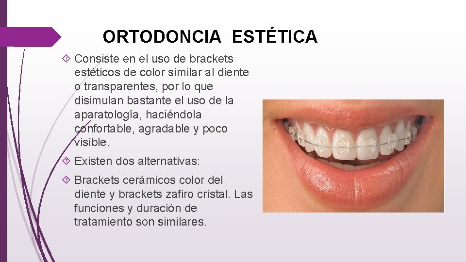 ORTODONCIA ESTÉTICA Consiste en el uso de brackets estéticos de color similar al diente