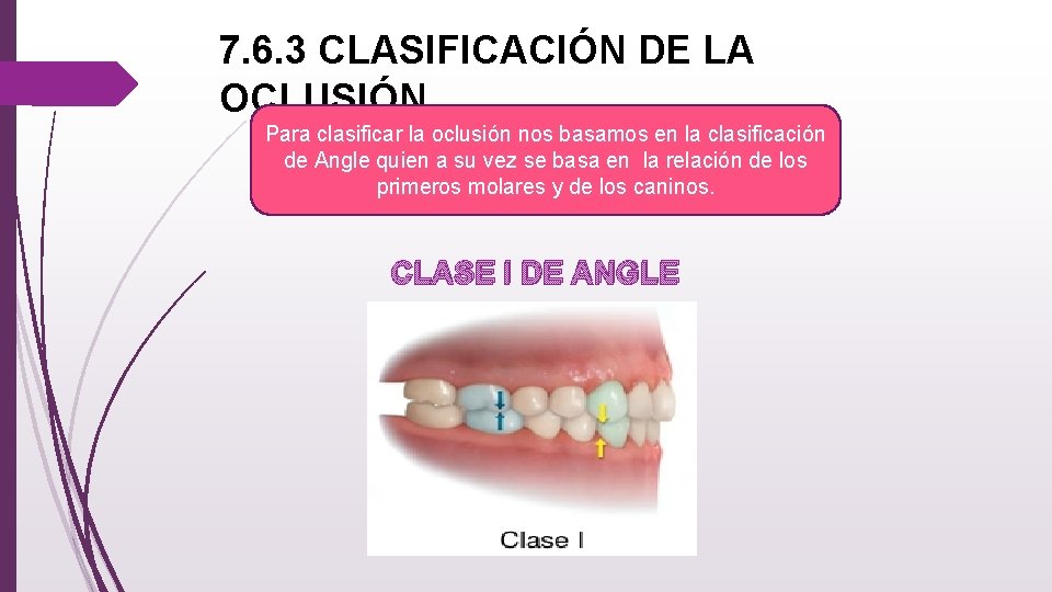 7. 6. 3 CLASIFICACIÓN DE LA OCLUSIÓN Para clasificar la oclusión nos basamos en