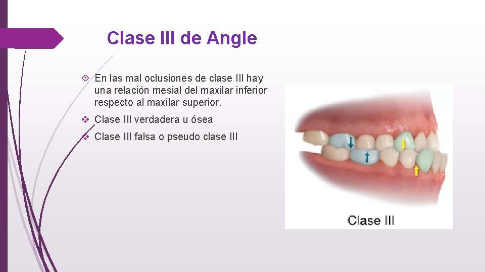 Clase III de Angle En las mal oclusiones de clase III hay una relación