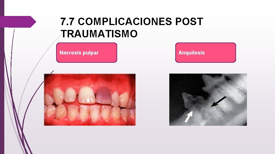 7. 7 COMPLICACIONES POST TRAUMATISMO Necrosis pulpar Anquilosis 