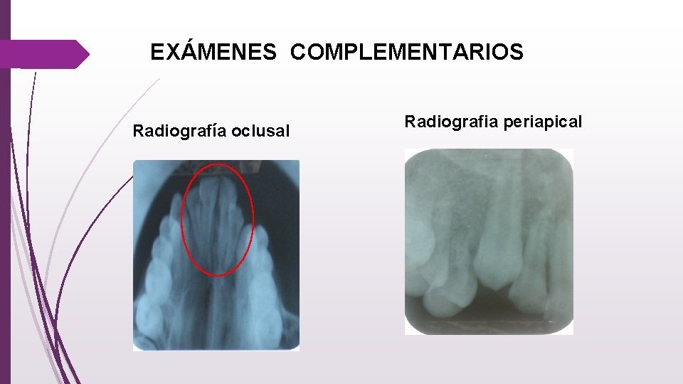 EXÁMENES COMPLEMENTARIOS Radiografía oclusal Radiografia periapical 