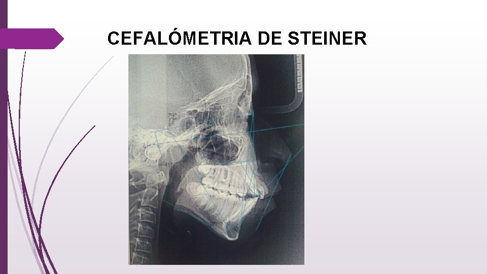 CEFALÓMETRIA DE STEINER 