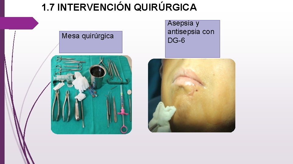 1. 7 INTERVENCIÓN QUIRÚRGICA Mesa quirúrgica Asepsia y antisepsia con DG-6 