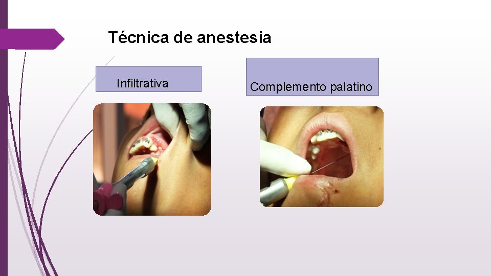 Técnica de anestesia Infiltrativa Complemento palatino 