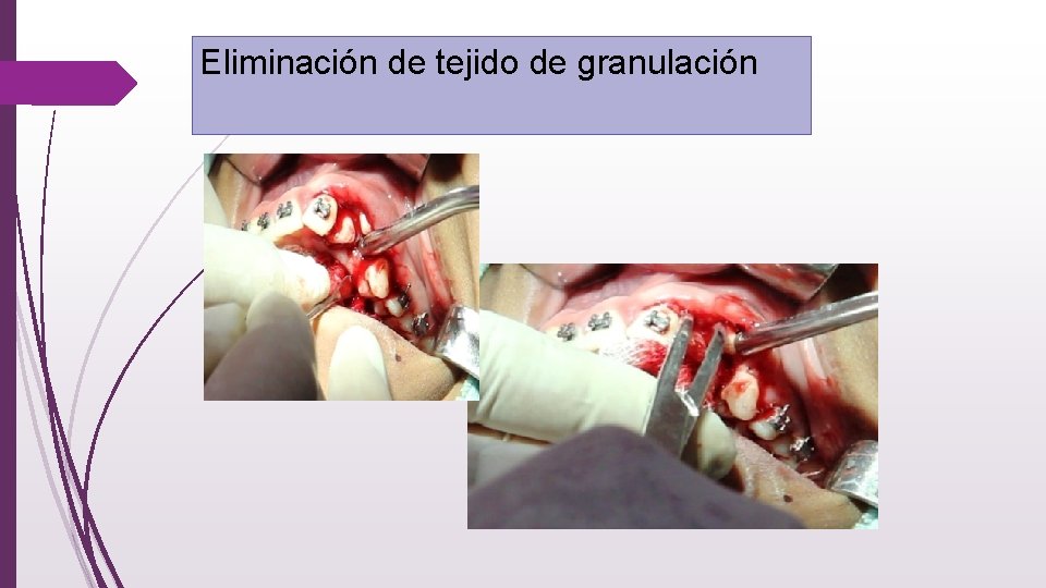 Eliminación de tejido de granulación 