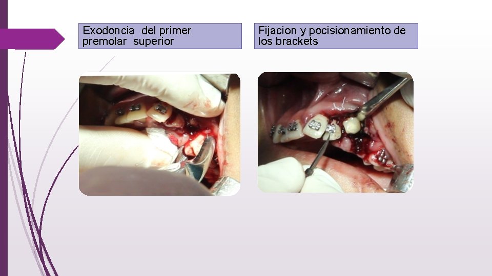 Exodoncia del primer premolar superior Fijacion y pocisionamiento de los brackets 