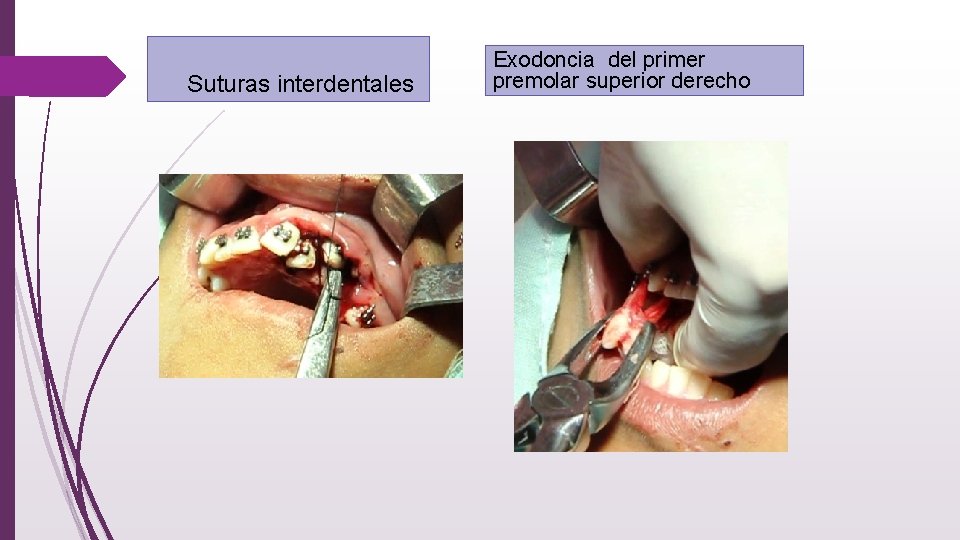  Suturas interdentales Exodoncia del primer premolar superior derecho 