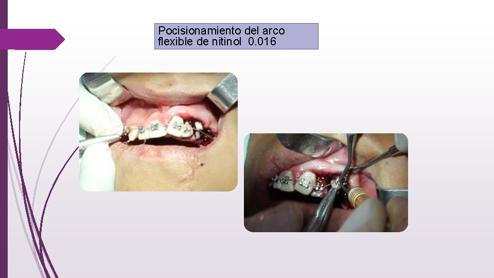 Pocisionamiento del arco flexible de nitinol 0. 016 